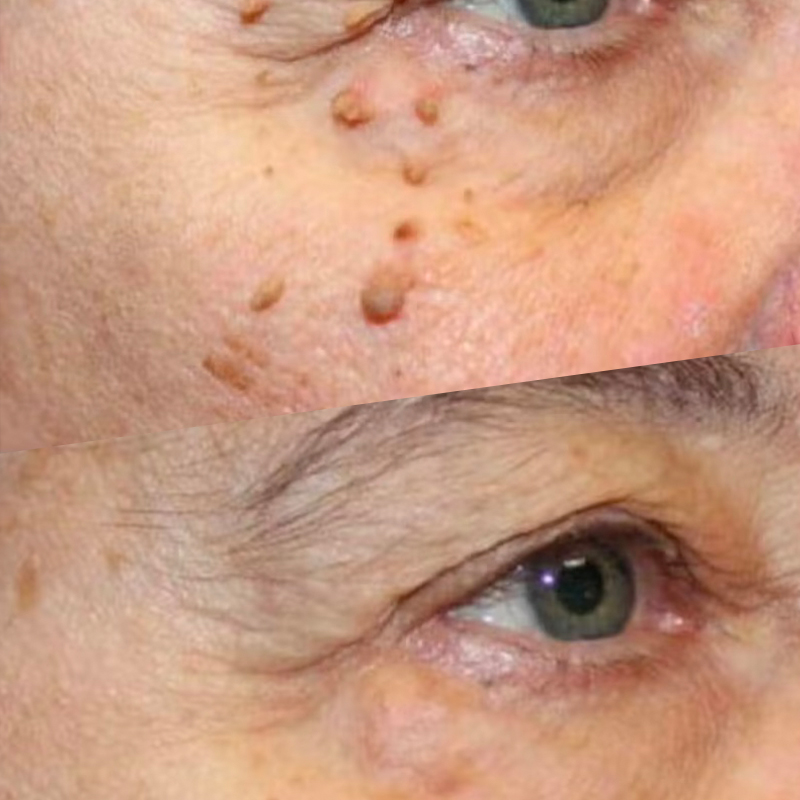 30-Minutes Skin-Tag Removal Session 30-Minutes Skin-Tag Removal Session