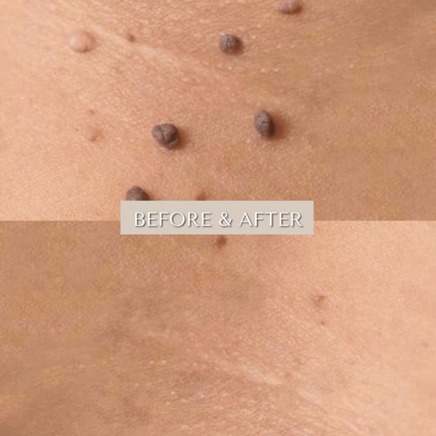 Single Skin Tag Removal 1–2" Skin Area Single Skin Tag Removal 1–2" Skin Area