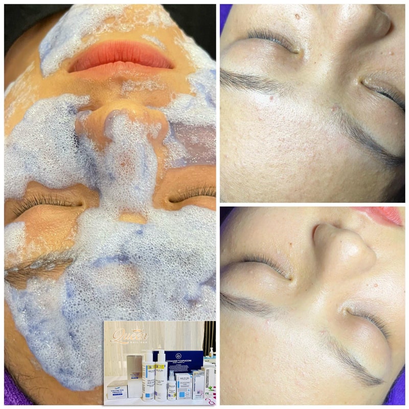 Vip Facial Vip Facial